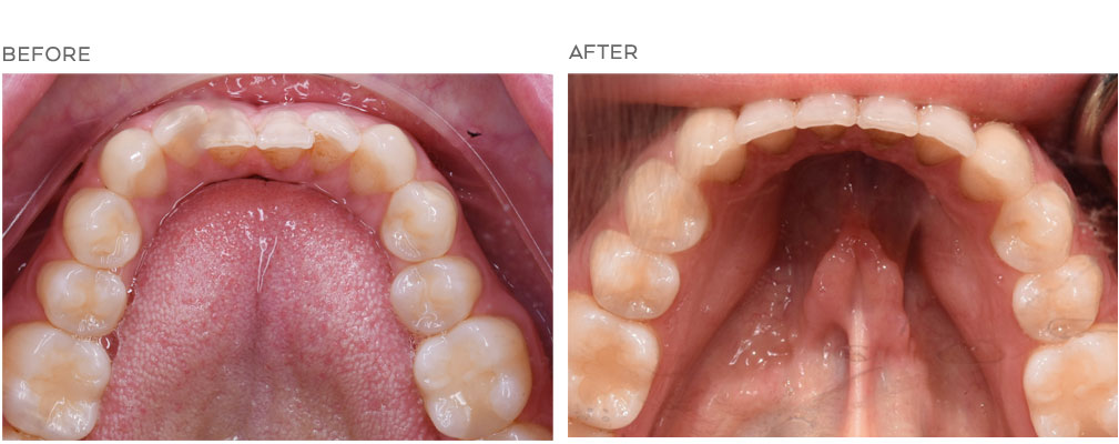 Before and after TMJ